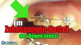 Im ZahnspangenNotfall der Bogen piekst feste Zahnspange Kieferorthopäde  Orthodentix [upl. by Shelli]