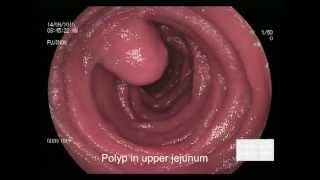 Jejunal polyp [upl. by Anawek]