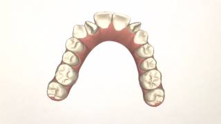 Patient 125 Invisalign movie [upl. by Nurse130]