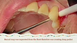 How To Diagnose Vertical Root Fractured Tooth [upl. by Zacharia114]