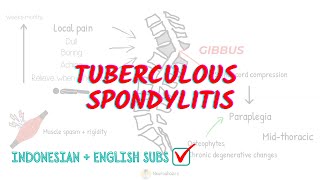 Tuberculous Spondylitis Overview and Treatment [upl. by Halford]