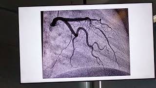 Mayer Miocardiopatía hipertrófica apical [upl. by Agni]