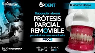 Elaboración de una Prótesis Parcial Removible para solucionar casos complicados [upl. by Arracot]