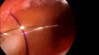 Arthroscopic Medial patella plication Dr A Reznik [upl. by Turne853]