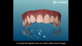 What is Invisalign [upl. by Benis]