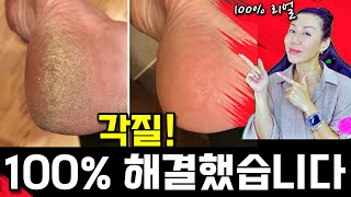 리얼체험 더이상 밀고 깎고 문지르지 마세요 발뒤꿈치 굳은살 각질 별짓 다해보다 드디어 100 아가발 만들었어요 [upl. by Mas351]