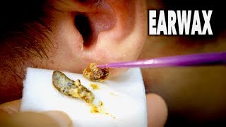 THE BEST EARWAX REMOVAL EVER and most gross  Dr Paul [upl. by Wallis]