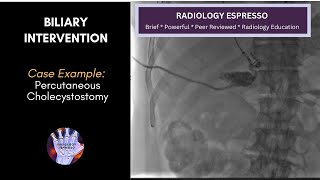 BILIARY INTERVENTION Case Example  PERCUTANEOUS CHOLECYSTOSTOMY [upl. by Adlitam]