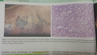 Kaposi Sarcoma  SPECIAL PATHOLOGY [upl. by Lefty]