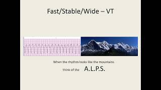 ACLS 2020 Algorithm Tachycardia [upl. by Annitsirhc]