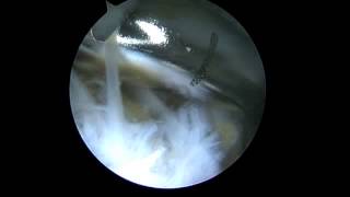 Epicondylite Tennis elbow  Arthroscopic treatment  Dr Falcone Clinique Jouvenet [upl. by Adiana]