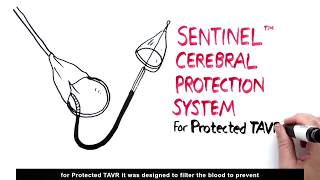 Patient amp Caregiver Whiteboard Animation SENTINEL™ Cerebral Protection System [upl. by Theda793]