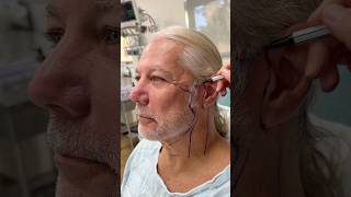 POV Day Of Your Deep Neck Facelift Interview [upl. by Edny331]