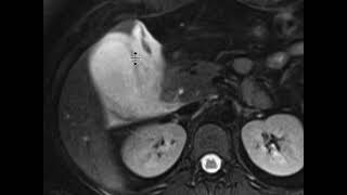 Acute Cholecystitis [upl. by Esetal]