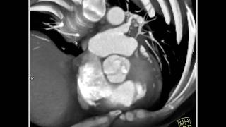 4D Imaging of the Aortic Valve Bicuspid valve 2 of 2 [upl. by Eillen]