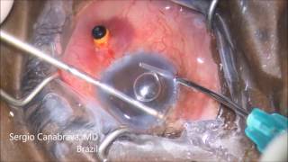 Anterior Vitrectomy in Posterior Capsular Rupture  By Dr Sergio Canabrava [upl. by Kerns]