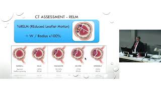 Leaflet Thrombosis in TAVI  Prof Greg Scalia [upl. by Eloken]