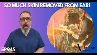 SO MUCH SKIN REMOVED FROM PATIENTS EAR CANAL  EP945 [upl. by Hukill]