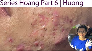 Acne Treatment Huong Da Nang 023  Series 6 Hoang Loyal fans [upl. by Anai]