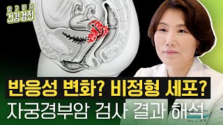 반응성세포변화는 정상인데 비정형 편평상피세포는 추가 검사 필요 HPV는 치료 안 해도 없어지나요 자궁경부암 검사 결과지 해석법 일산차병원 산부인과 노주원 교수 [upl. by Neu]