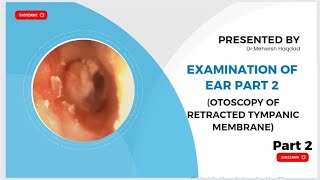 Examination of Ear part2 Otoscopy of Retracted tympanic membrane  ENT Made easy by Dr Mishi Bhatti [upl. by O'Malley]