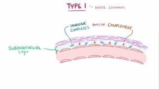 Membranoproliferative glomerulonephritis MPGN causes symptoms amp pathology [upl. by Ees]