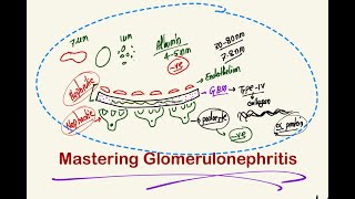 Calculative Glomerulonephritis [upl. by Gruver]