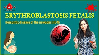 ERYTHROBLASTOSIS FETALIS II Hemolytic disease of the newborn HDN [upl. by Akenahs]