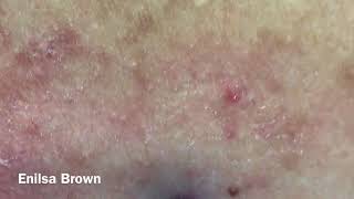 Christians Acne Back Treatment Blackheads Extractions [upl. by Ahsyekat]