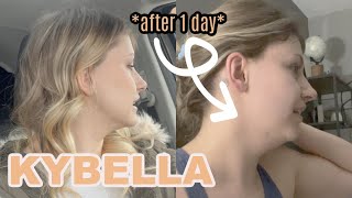 TRYING KYBELLA Process amp Day 1 Swelling  369 [upl. by Stoller]