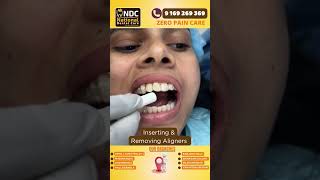 Aligner Tips  Inserting And Removing Aligners safely  Best Dental Hospital In Hyderabad  NDC [upl. by Cesaria]