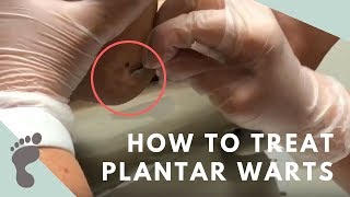 How To Treat Plantar Warts [upl. by Adalai]