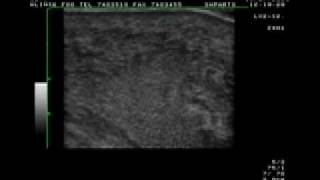 Skin abscess detection using sonography [upl. by Nnylasor374]