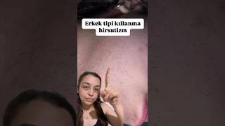 Erkek tipi kıllanma hirsutizm shots keşfet reels güzellik hirsutism keşfet shortsviral [upl. by Airtina]