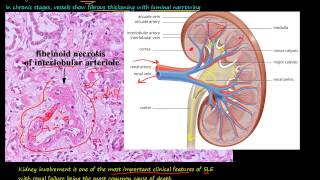 90P Morphology of Systemic lupus erythematosus SLE part 1 [upl. by Packton867]