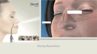 Introduction to Powered Microsaw Rhinoplasty By BienAir  Video 1 [upl. by Raffaello]