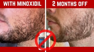 What Happened When I Stopped Minoxidil for Beard Growth [upl. by Ardnak]