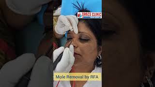 Mole removal by RFA single sitting  Grace Clinic Dehradun  Treatment of Mole [upl. by Debora]