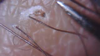 SCAB reveals ingrown hair which is then removed 59 [upl. by Vickey]