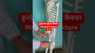 कुल्हे की हड्डी का फ्रैक्चर  Hip Joint Fracture  Femur Bone shorts viral youtubeshorts [upl. by Alansen223]