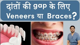 Indias Most Popular Teeth Gap Treatment Options 2024  Dental veneers in India Braces in Indore [upl. by Tolmann321]