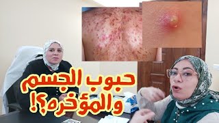 كيفية التخلص من حبوب الجسم والمؤخره💟لكل عروسه 💞للمراهقات [upl. by Sewole143]