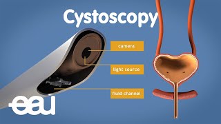 Cystoscopy overactive bladder [upl. by Alviani217]