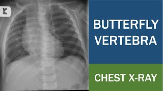 Butterfly Vertebra  Sagittal Cleft Vertebra  Anterior Rachischisis  Chest Xray [upl. by Oreves]