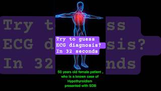 ecgdiagnosis hypothyroid hypothyroidism cardiology ecganalysis [upl. by Aleetha523]