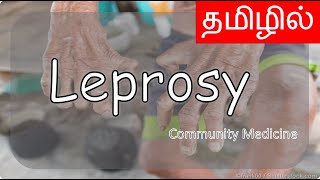 Leprosy  தமிழில்  Community medicine  Tamil  MBBS [upl. by Ennaoj]