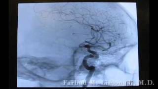 3D Cerebral Angiography [upl. by Dace]