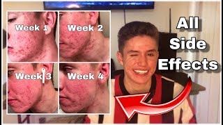 I Took Accutane For 1 Month amp THIS Is What Happend  Accutane Before amp After  Side Effects [upl. by Femi499]