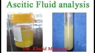 Ascitic fluid analysis تحليل السائل البريتوني [upl. by Meier]