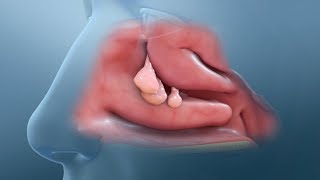 Nasal Polyp Removal Surgery [upl. by Delcine152]